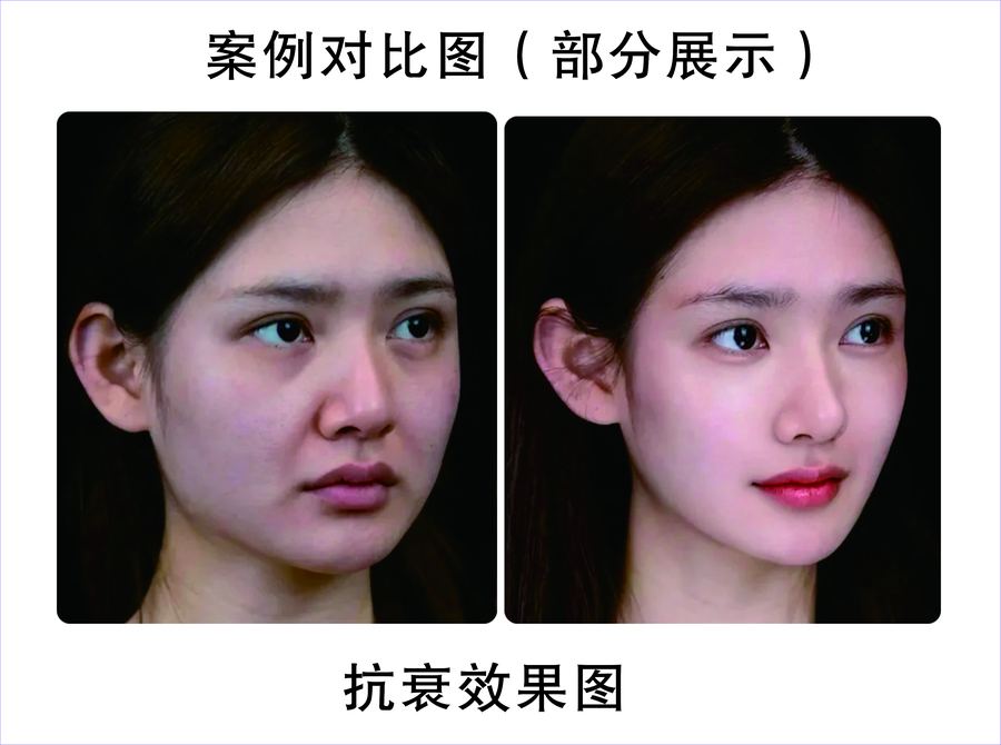 平皺抗衰真人案例對比